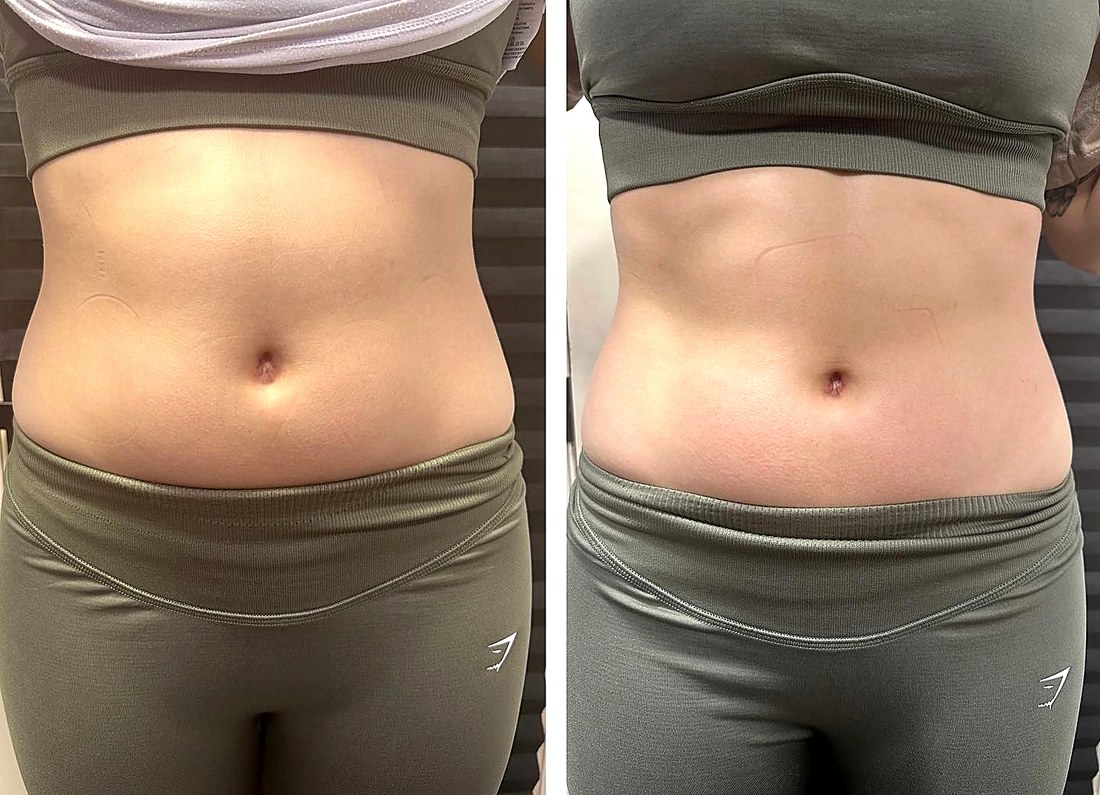 Before and after:abdomen
