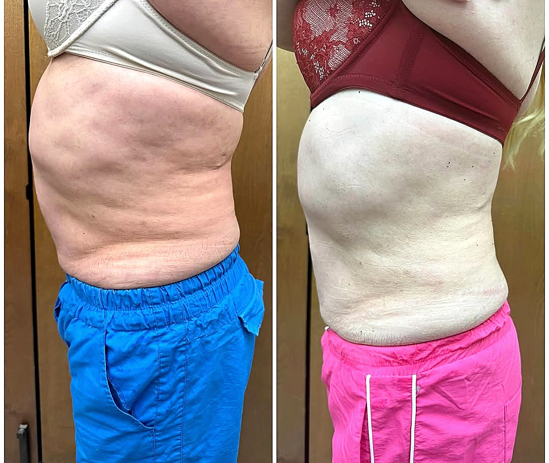 Before and after:flank
