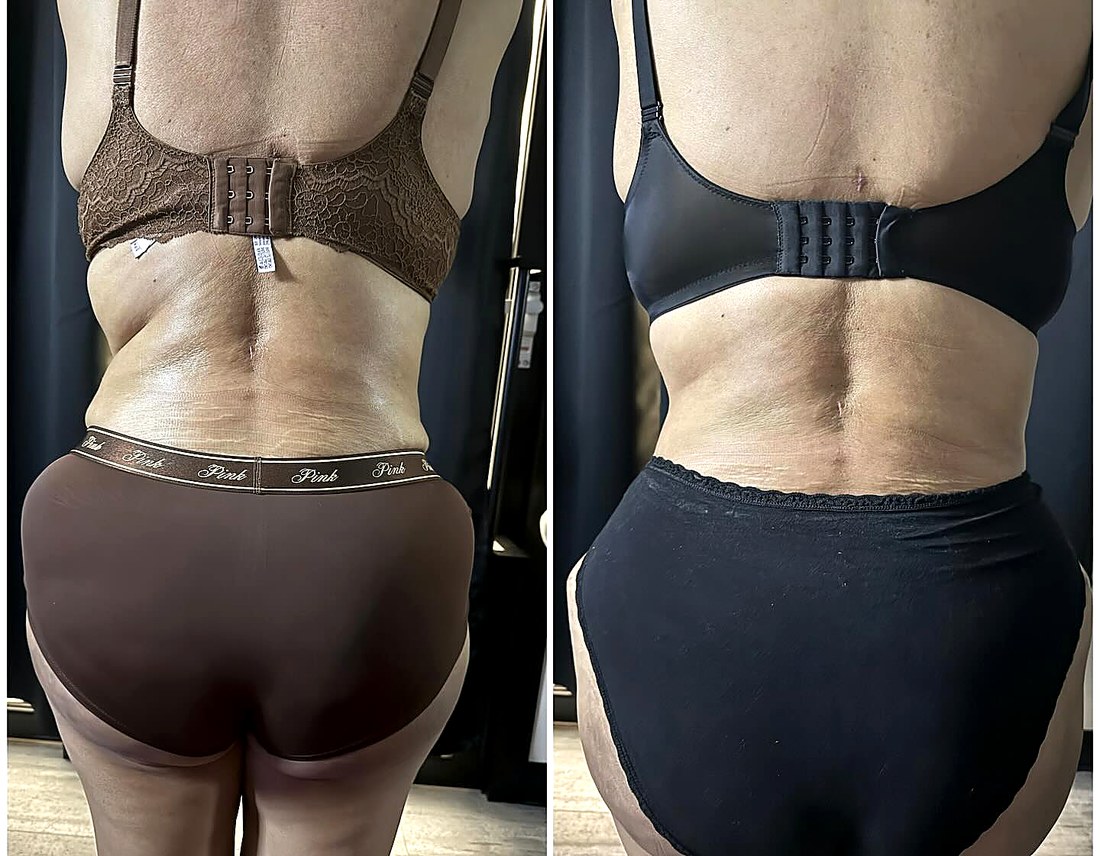 Before and after:back